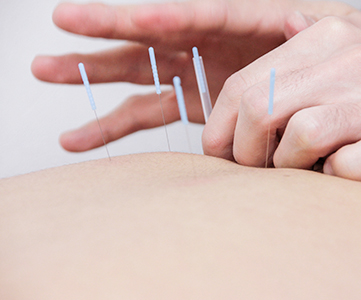 acupuncture-treatment_16